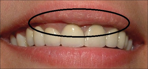 Sức khỏe, đời sống: Các biến chứng có thể xảy ra khi bọc răng sứ Bien-chung-co-the-xay-ra-khi-boc-rang-su