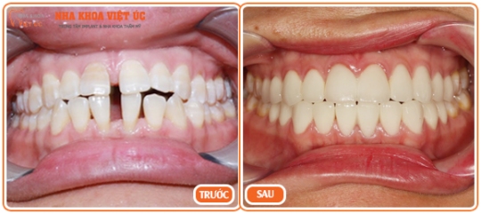Chia sẻ kinh nghiệm bọc răng sứ hiệu quả Boc-rang-su-cho-rang-thua