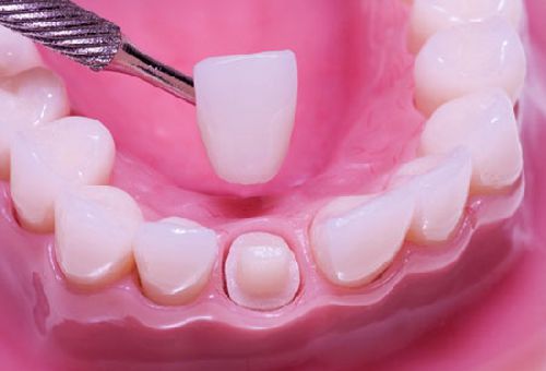 Toàn quốc - Quy trình bọc răng sứ chuẩn Quốc tế là như thế nào? Boc-rang-su-theo-quy-trinh-chuan-quoc-te