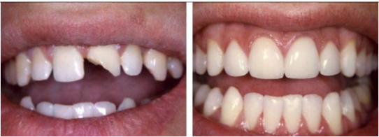 Sức khỏe, đời sống: Có nên bọc răng sứ cho răng cửa hay không ? Hinh-anh-benh-nhan-truoc-va-sau-khi-boc-rang-su-cho-rang-cua