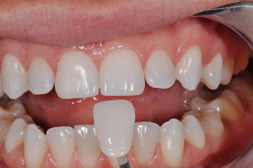 Có nên bọc răng sứ cho răng cửa hay không ? Nen-boc-rang-su-loai-nao-cho-rang-cua